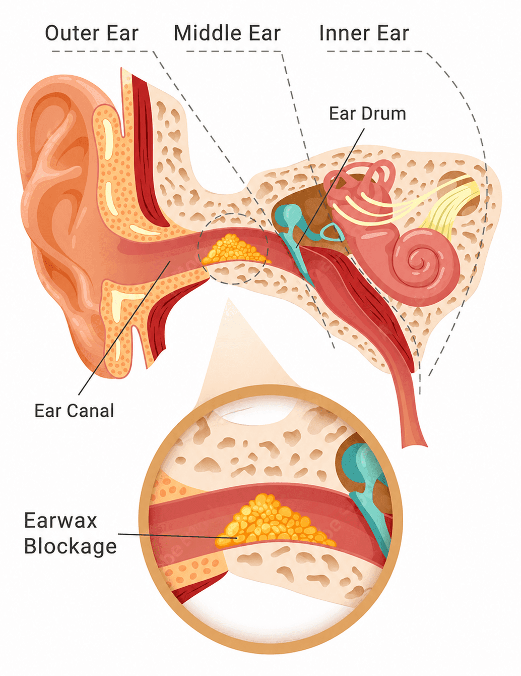 Diagrama anatómico que muestra cerumen en el canal auditivo